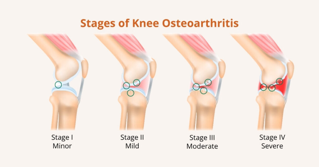 what are the stages of knee osteoarthritis