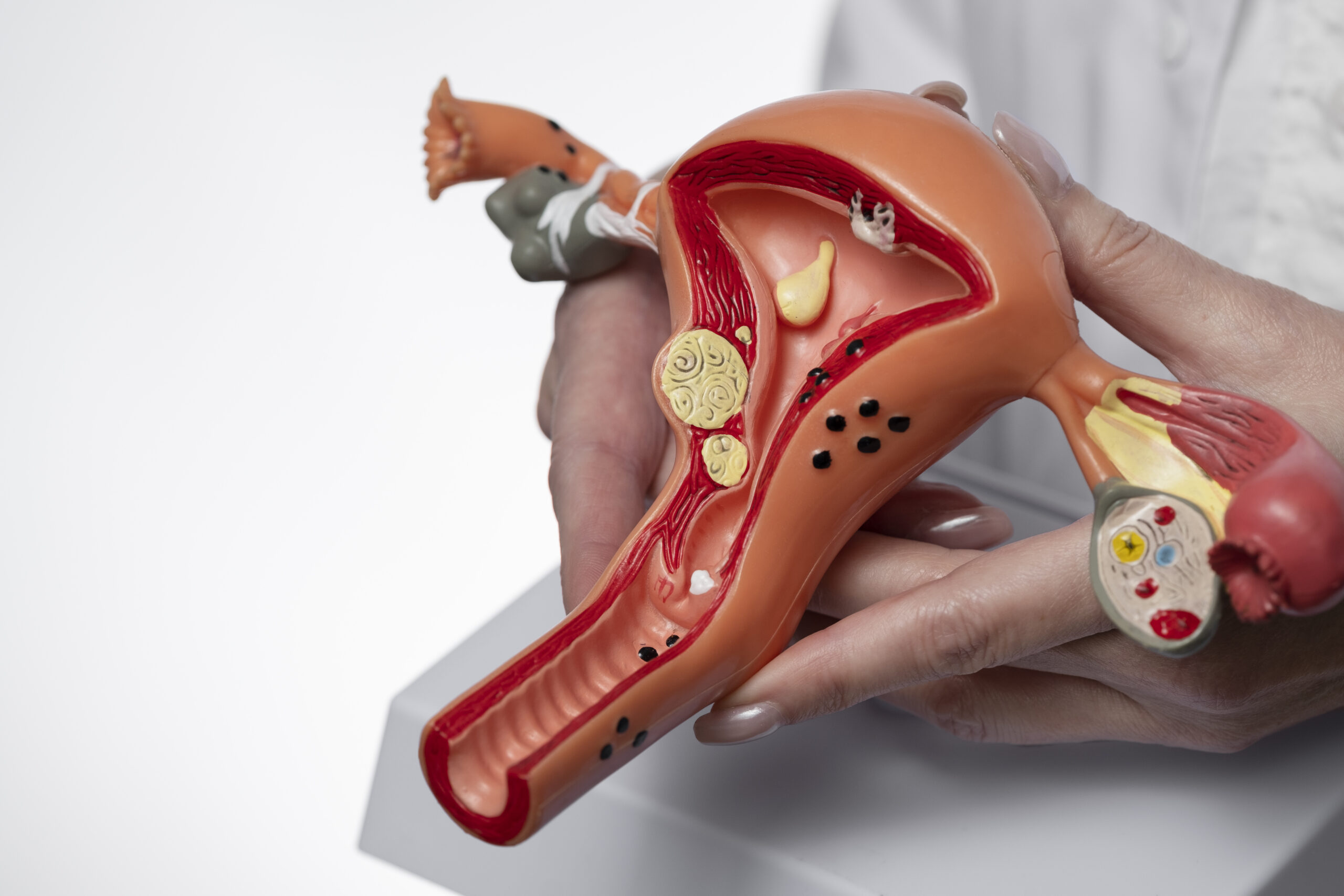 Can Fibroids Be Cancerous?